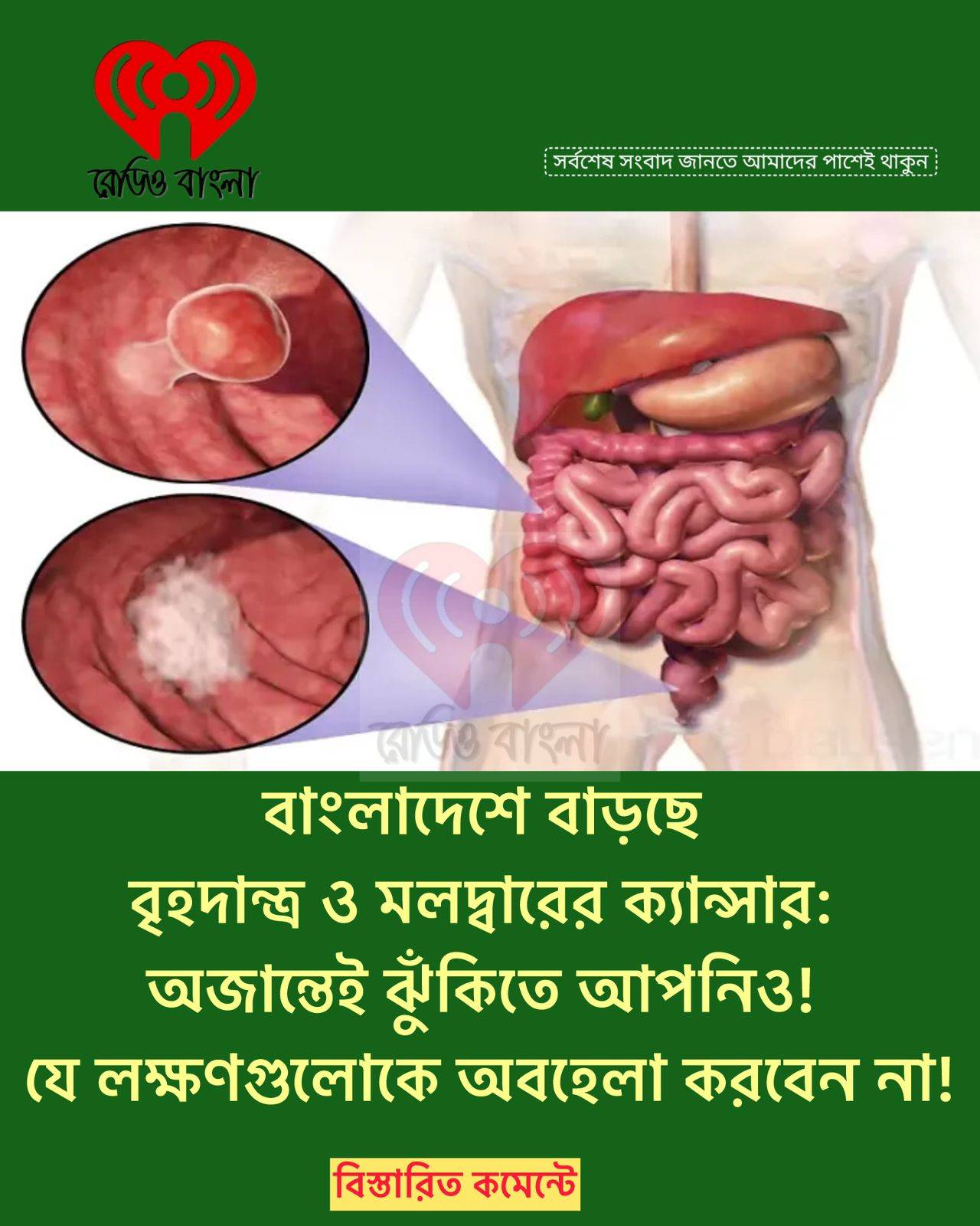 বাংলাদেশে বাড়ছে বৃহদান্ত্র ও মলদ্বারের ক্যান্সার: অজান্তেই ঝুঁকিতে আপনিও! যে লক্ষণগুলোকে অবহেলা করবেন না!