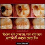 দাঁ’তের গ’র্ত কেন হয়, আর গ’র্ত হলে আপনি কী করবেন জেনে নিন