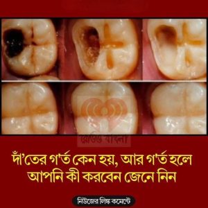 দাঁ’তের গ’র্ত কেন হয়, আর গ’র্ত হলে আপনি কী করবেন জেনে নিন