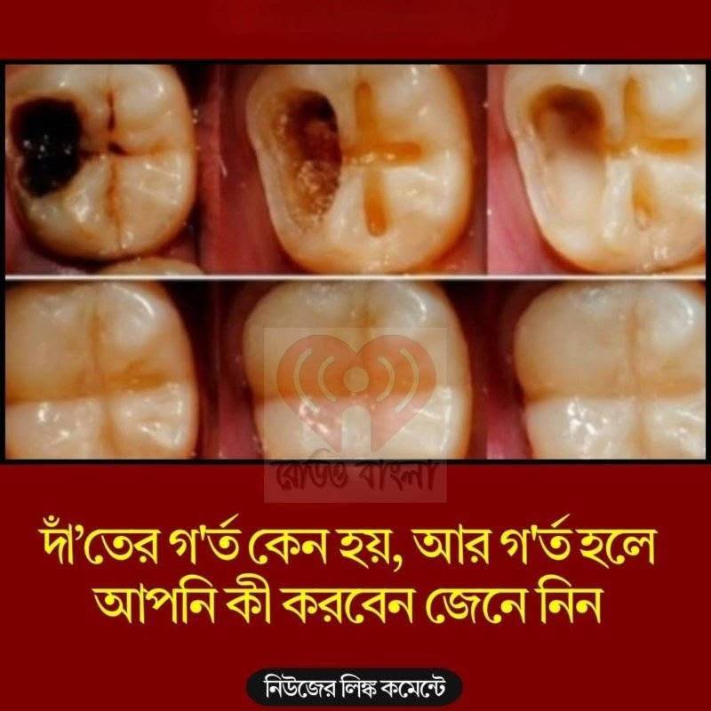 দাঁ’তের গ’র্ত কেন হয়, আর গ’র্ত হলে আপনি কী করবেন জেনে নিন
