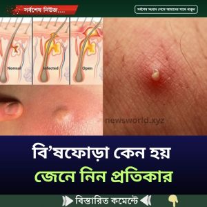 বিষফোঁড়া কেন হয়, জেনে নিন প্রতিকার