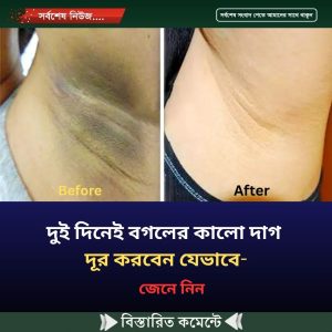 দুই দিনেই বগলের কালো দাগ দূর করবেন যেভাবে