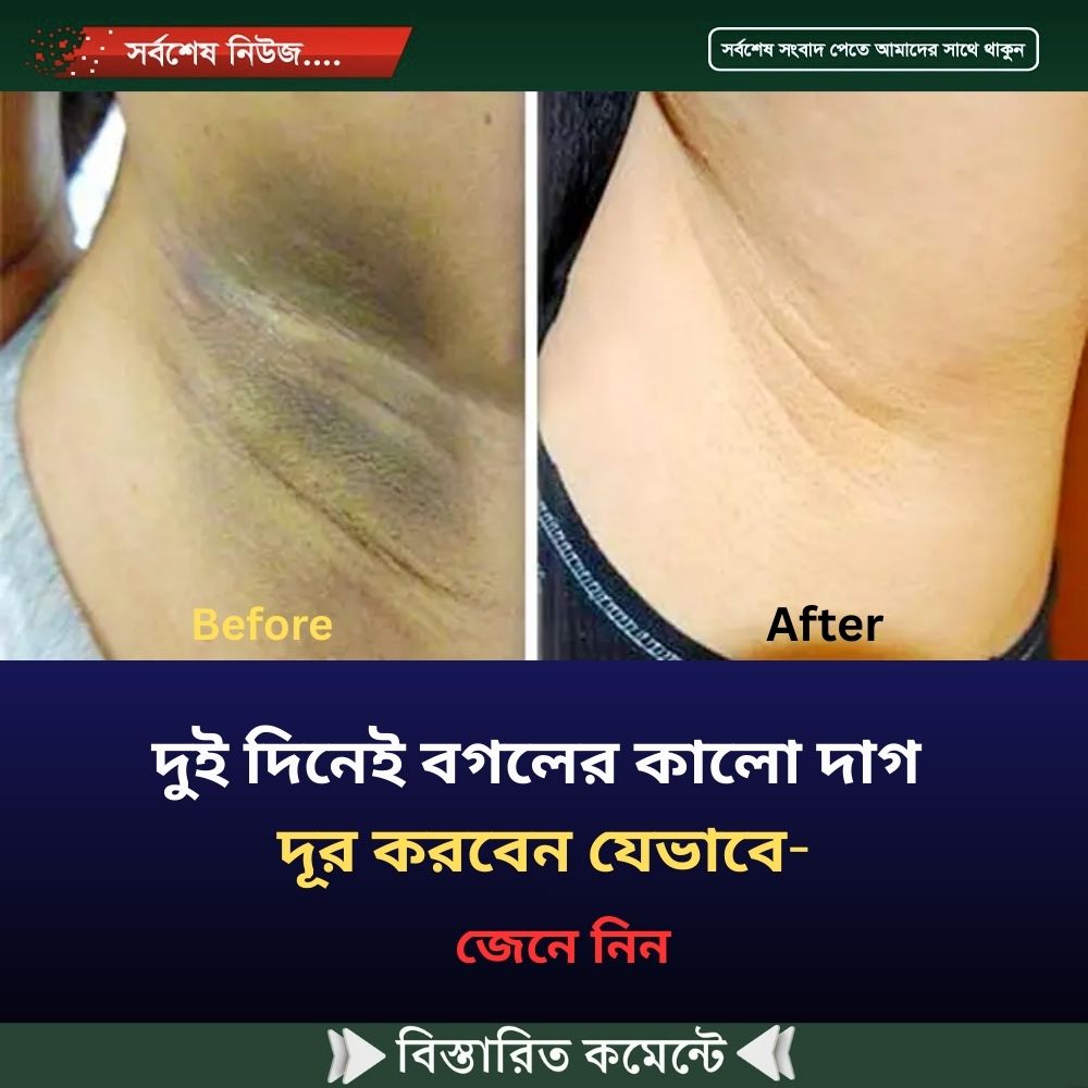 দুই দিনেই বগলের কালো দাগ দূর করবেন যেভাবে