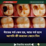 দাঁ’তের গ’র্ত কেন হয়, আর গ’র্ত হলে আপনি কী করবেন জেনে নিন