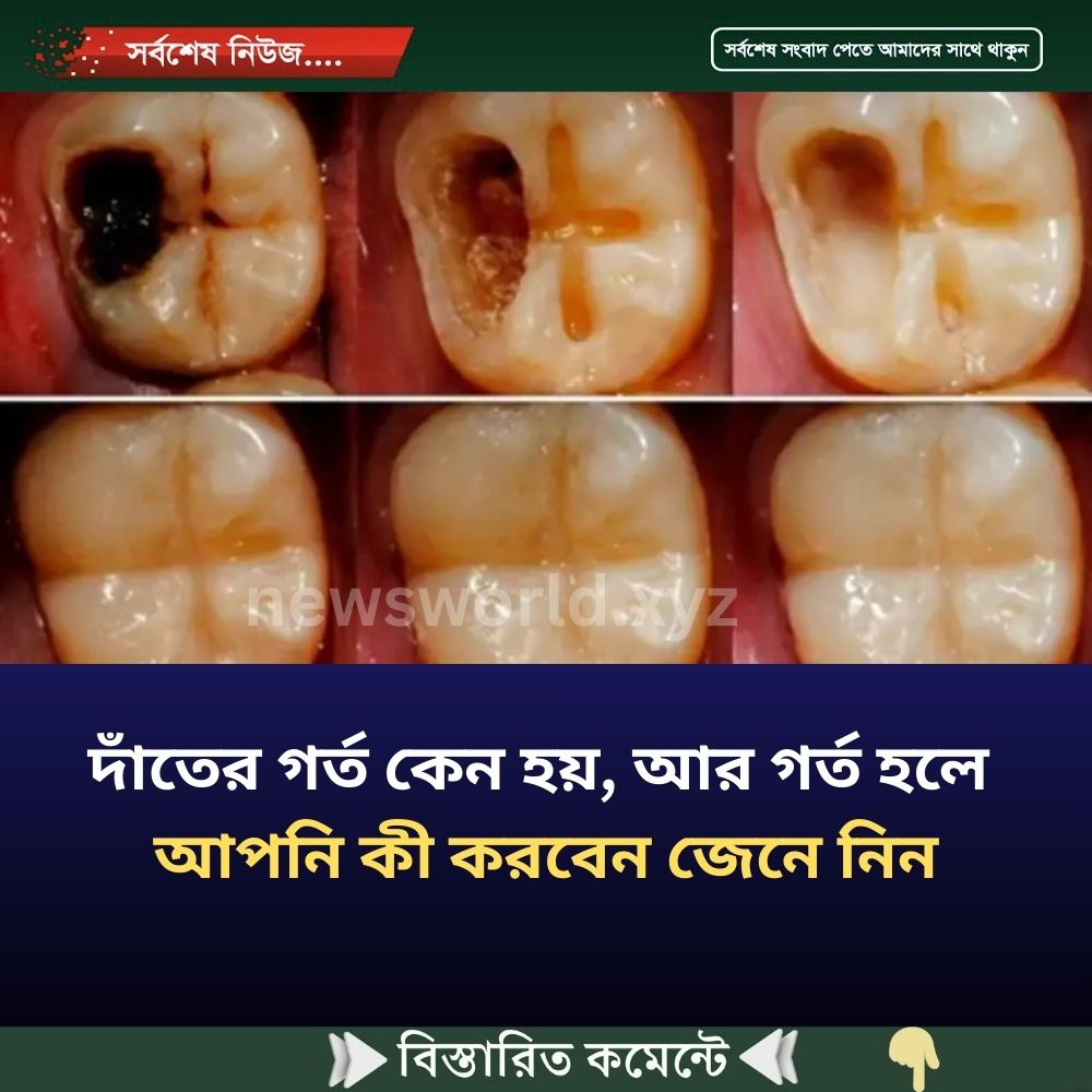 দাঁ’তের গ’র্ত কেন হয়, আর গ’র্ত হলে আপনি কী করবেন জেনে নিন