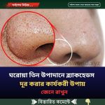 ঘরোয়া কোন উপাদান ব্ল্যাকহেডস দূর করার কার্যকরী উপায়