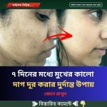 ৭ দিনের মধ্যে মুখের কালো দাগ দূর করার দুর্দান্ত উপায়