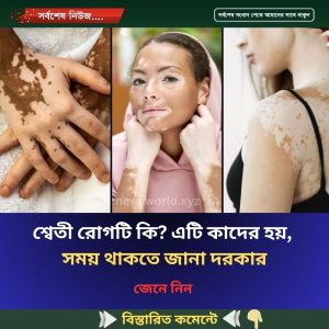 শ্বেতী রোগটি কি? এটি কাদের হয়, সময় থাকতে জানা দরকার