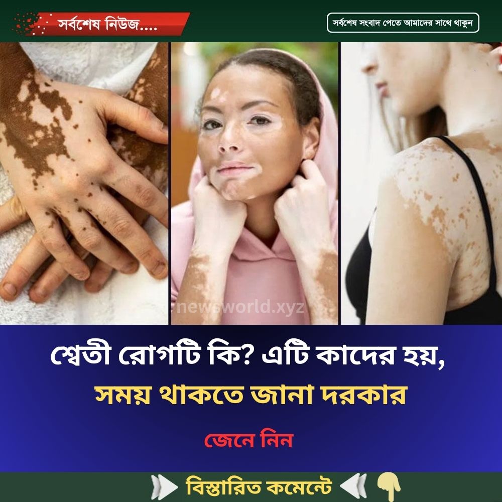 শ্বেতী রোগটি কি? এটি কাদের হয়, সময় থাকতে জানা দরকার