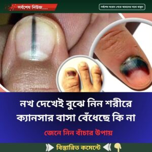 নখ দেখেই বুঝে নিন শরীরে ক্যানসার বাসা বেঁধেছে কি না
