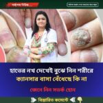 হাতের নখ দেখেই বুঝে নিন শরীরে ক্যানসার বাসা বেঁধেছে কি না
